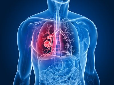 Las exposiciones ambientales y los determinantes sociales son clave en pacientes con fibrosis pulmonar