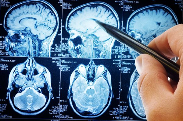 Una nueva herramienta basada en la Inteligencia Artificial permitirá mejorar el diagnóstico de tumores cerebrales