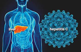 "Si eliminamos la hepatitis C, acabaremos con un problema de salud p\u00fablica"