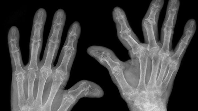 Tofacitinib es efectivo contra la artritis psoriásica