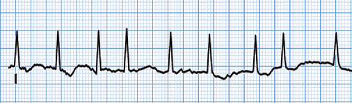 CASTLE-AF: La mortalidad desciende después de la ablación de la fibrilación auricular en la insuficiencia cardiaca