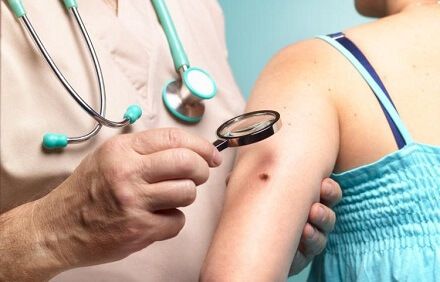 Disección de ganglios linfáticos no aumenta supervivencia en melanoma