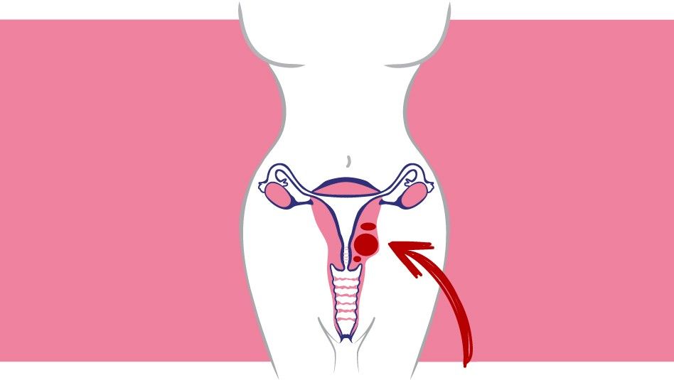 Embarazo ectópico retroperitoneal primario