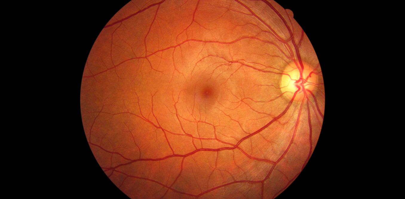 Los médicos restablecen la vista en dos pacientes con ceguera común