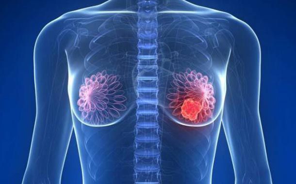 El estroma tumoral, en el punto de mira de la investigación en el cáncer de mama triple negativo