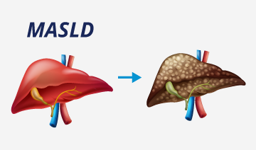 NAFLD/MASLD/MAFLD: Disfunción metabólica asociada a hígado graso.