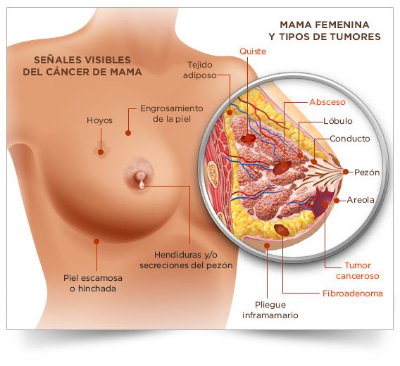 Casos clínicos. Variedad adenoescamosa del carcinoma metaplásico de mama: un hallazgo infrecuente. Reporte de caso.