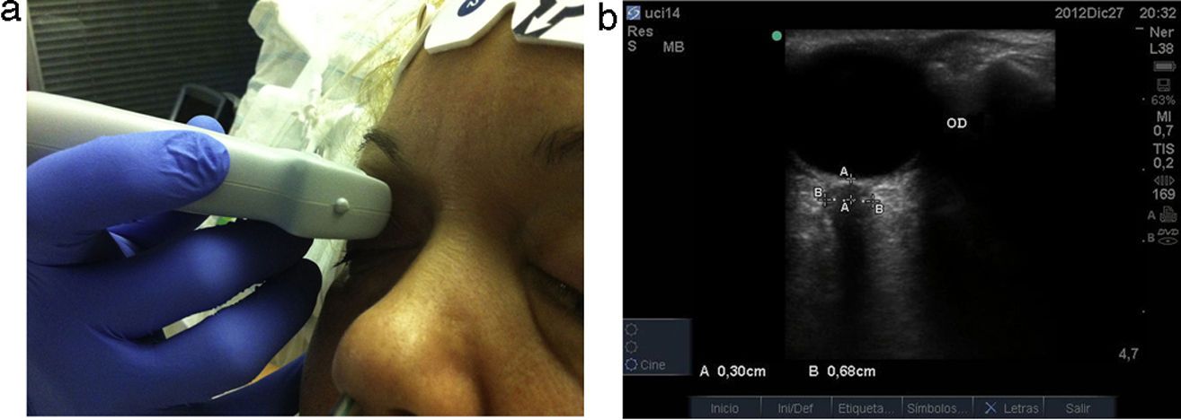 Medición del diámetro de la vaina del nervio óptico por ultrasonografía versus tomografía simple de cráneo en pacientes con trauma craneoencefálico