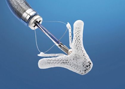 Se implanta un nuevo sistema mínimamente invasivo para la reparación de la válvula mitral