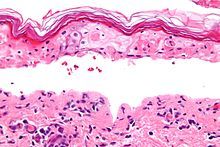 Superposición de síndrome de Stevens Johnson/necrólisis epidérmica tóxica asociada con hipogammaglobulinemia en el periodo neonatal: informe de caso