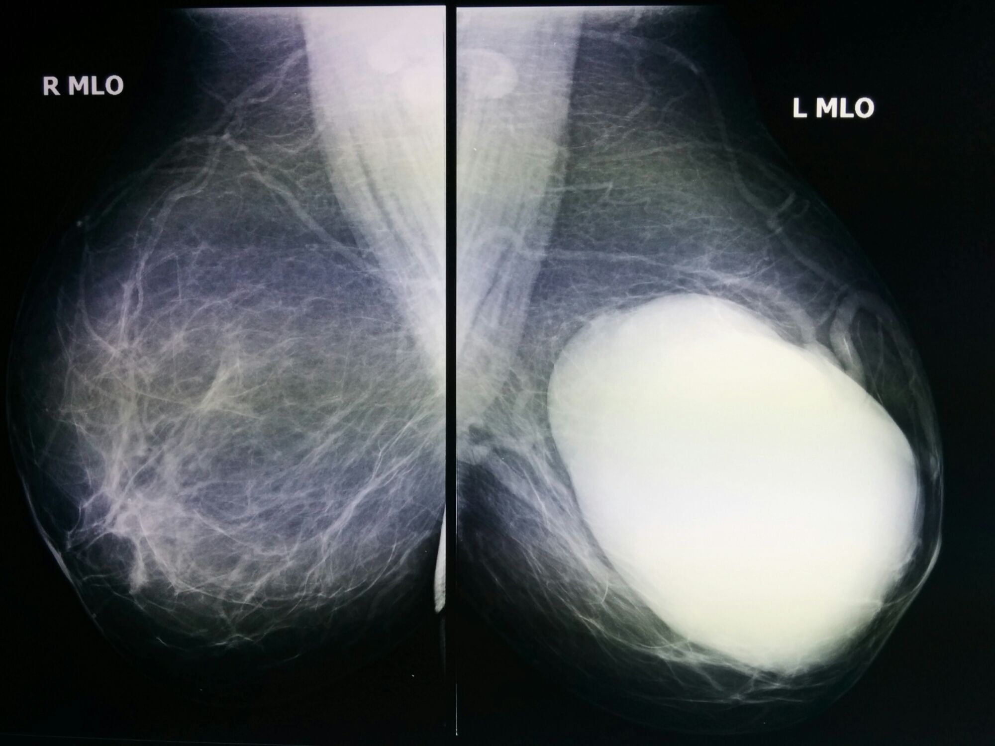 Tumor Phyllodes con transformación a osteosarcoma