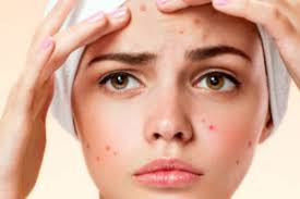 ¿Por qué algunas personas sufren de acné severo? Gran estudio genético revela que la formación de folículos pilosos puede ser clave