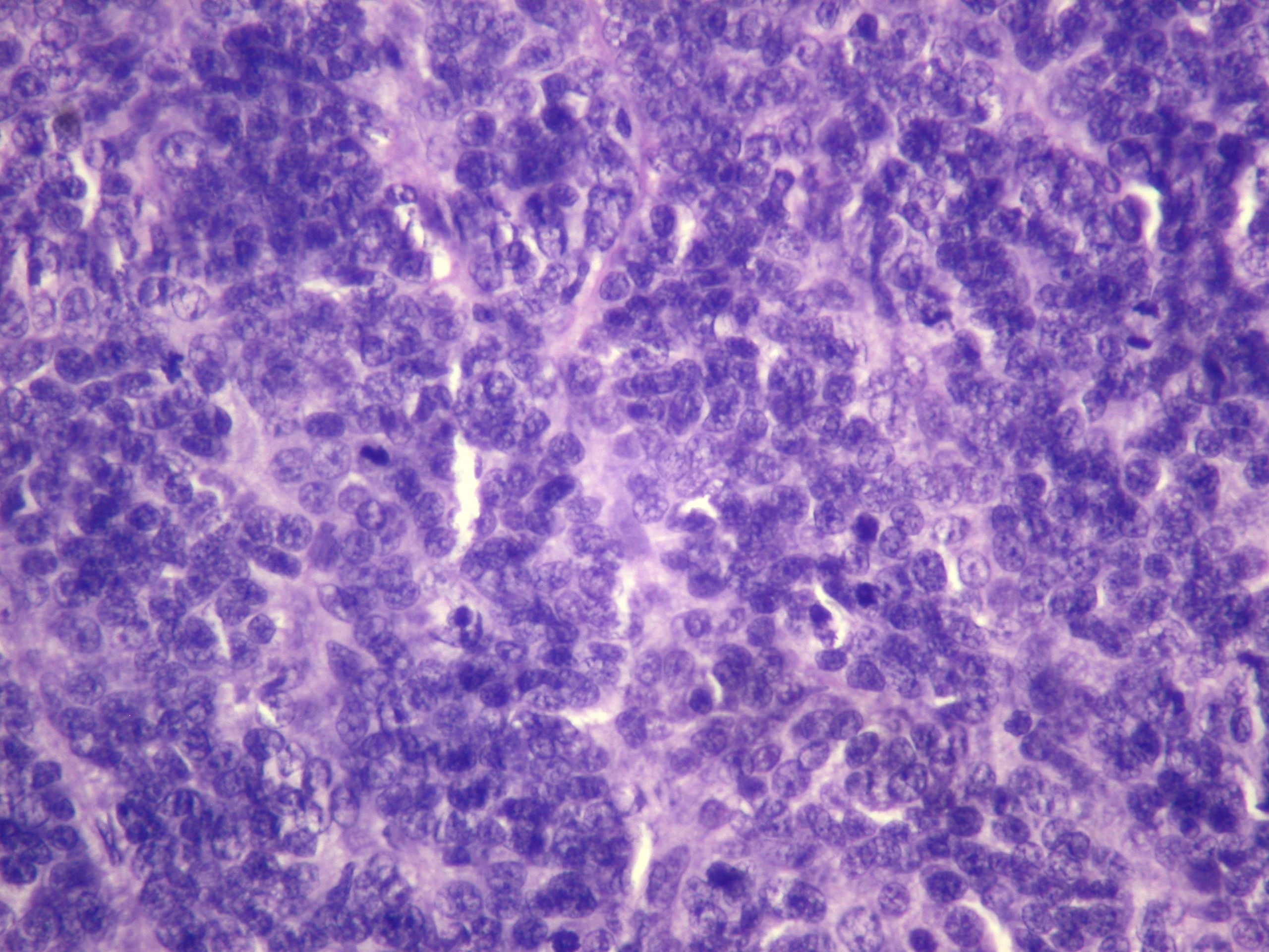 Carcinoma con diferenciación ecrina/apocrina vulvo perineal. Caso clínico y revisión de la literatura