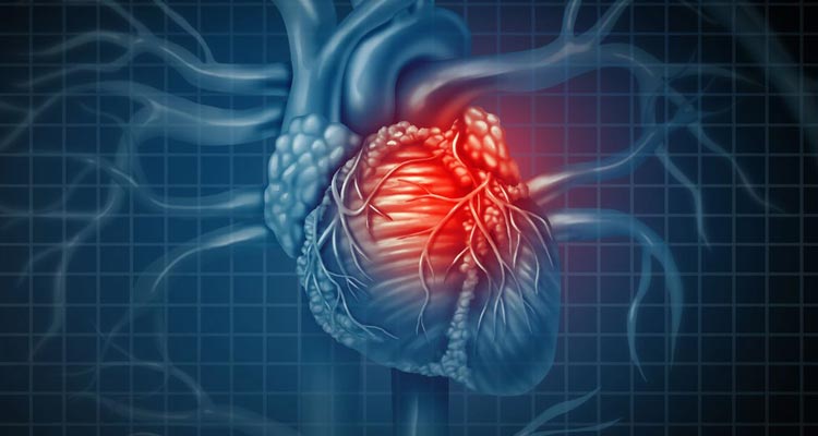 Cuarta definición de infarto agudo de miocardio. Consideraciones anestésicas perioperatorias