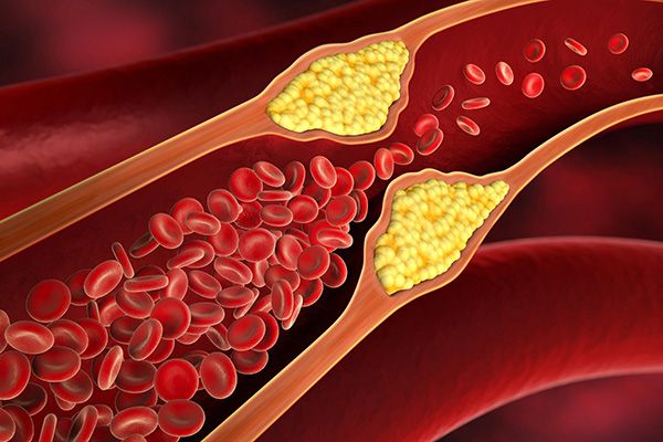 Inflamación de placa aterosclerótica contribuiría a que hígado graso progrese a fibrosis hepática