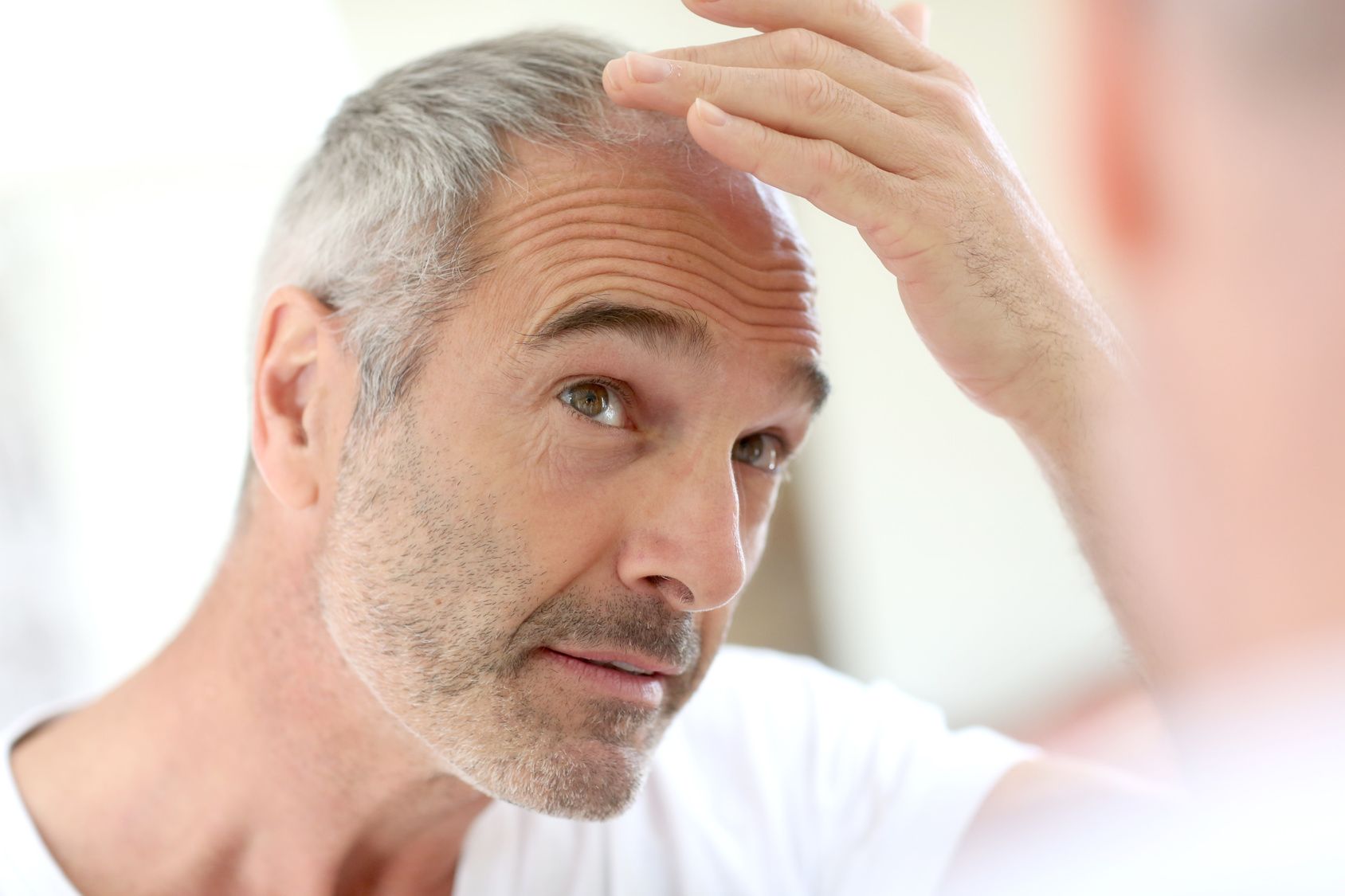 Alopecia areata: Sildenafil también hace crecer el cabello