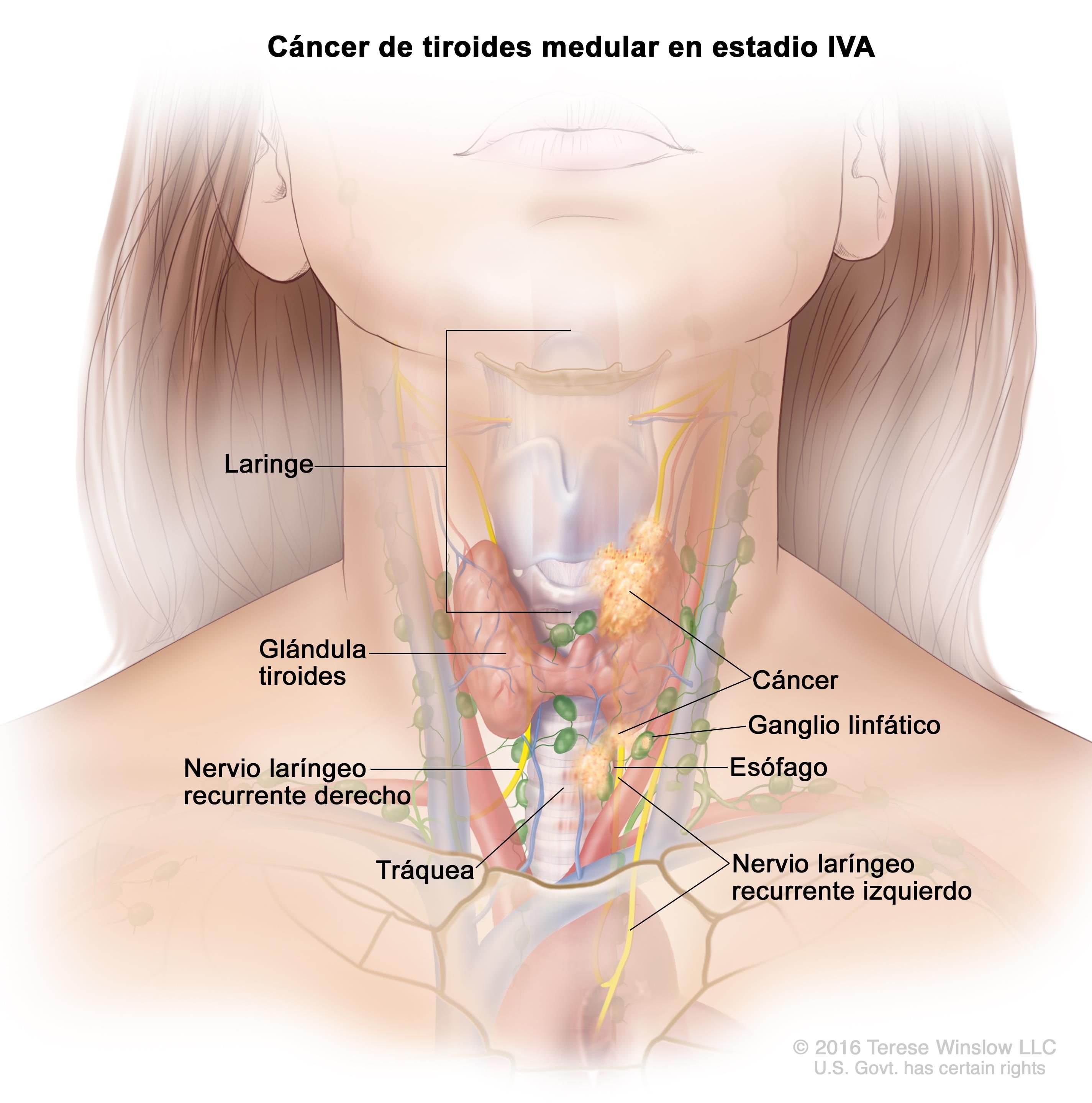 El papel del endocrino es clave para decidir el tratamiento de los carcinomas de tiroides