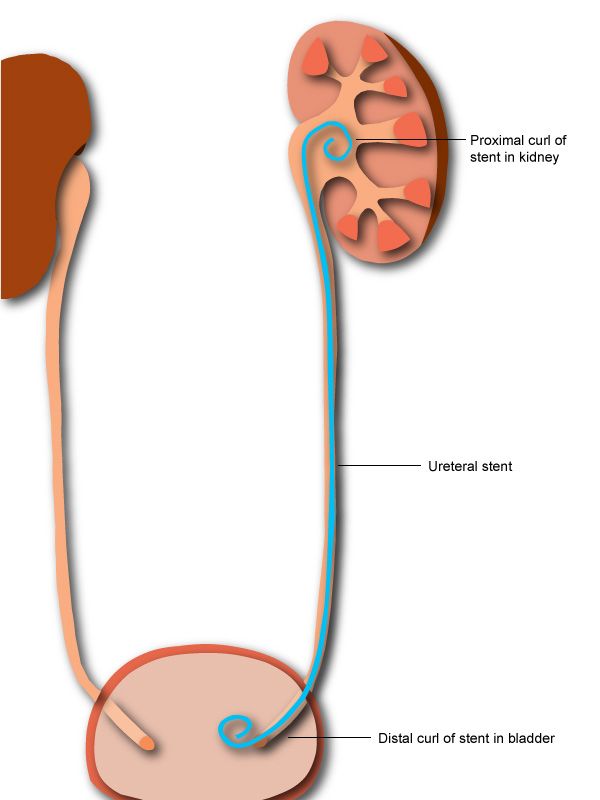 Uso de catéter doble J en ureteroscopias por litiasis ureteral
