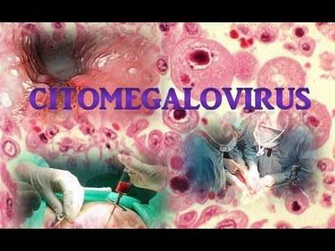 La infección por citomegalovirus postrasplante renal y pérdida del injerto a largo plazo