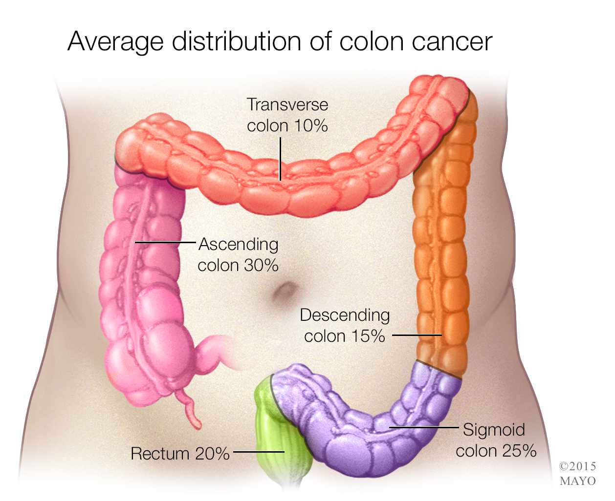Sintomas de cancer de colon con metastasis en higado