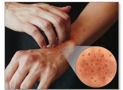 Dermatitis granulomatosas reactivas: dermatitis granulomatosa intersticial y dermatitis granulomatosa neutrofílica en empalizada