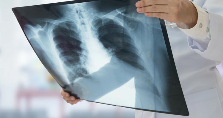 Nódulo pulmonar cavitado en artritis reumatoide: reporte de un caso