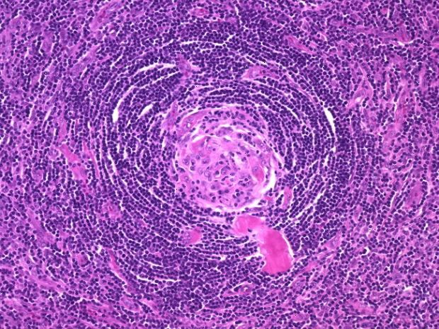 Linfoma de células grandes B originado en enfermedad de Castleman. Reporte de un caso y revisión de la literatura