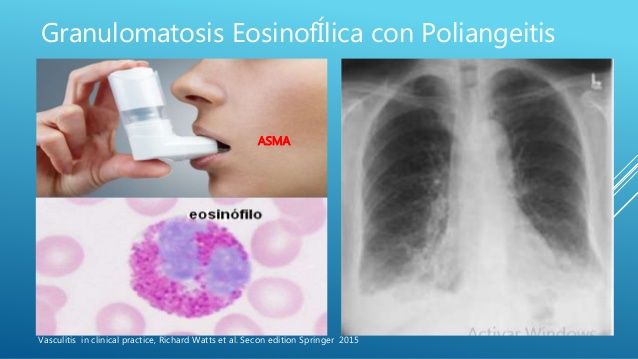 Linfoma y granulomatosis eosinofílica con poliangeitis (síndrome de Churg-Strauss): reporte de un caso