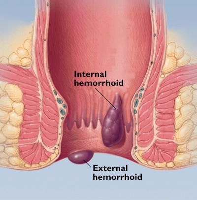 Los síntomas hemorroidales pueden esconder otras patologías digestivas