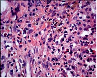 Histiocitosis de células de Langerhans: nuevos conceptos moleculares y clínicos