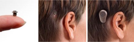 Implantación coclear en pacientes de edad avanzada: Resultados auditivos