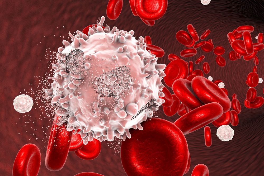 Una nueva técnica con células CAR-T logra la remisión de un tipo de leucemia fatal