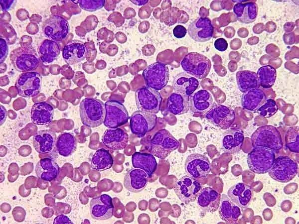 Leucemia mieloide crónica en remisión molecular mayor después de 44 meses sin tratamiento