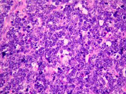 Linfoma no Hodgkin de Células T Angioinmunoblástico