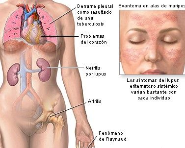 Lupus Eritematoso Sistémico: generalidades sobre su fisiopatología, clínica, abordaje diagnóstico y terapéutico