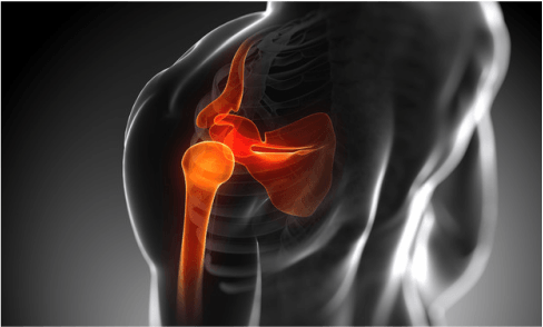 La lesión del manguito rotador de hombro es la tercera más frecuente del sistema musculoesquelético