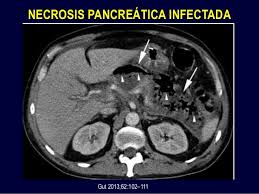 Análisis microbiológico de la necrosis infectada en la pancreatitis aguda grave