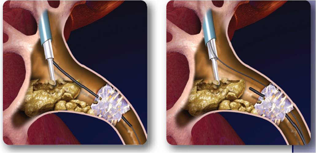 Comparación de efectividad y morbilidad de nefrolitotomía endoscópica flexible vs. percutánea para cálculos renales entre 15-25 mm