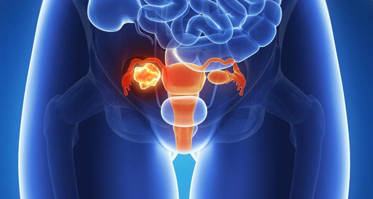 La ovariectomía bilateral puede aumentar el riesgo de desarrollar demencia