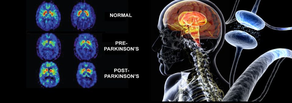La psicosis en la enfermedad de Parkinson no sólo está asociada al uso de medicamentos dopaminérgicos, sino que forma parte del proceso de la propia enfermedad