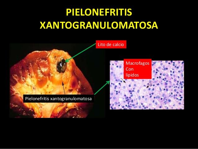 Pielonefritis xantogranulomatosa: un reto actual para la laparoscopia