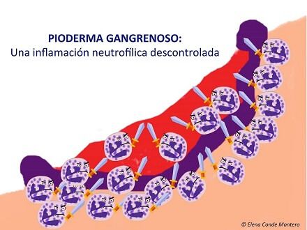 Hidradenitis Supurativa asociada a Pioderma Gangrenoso