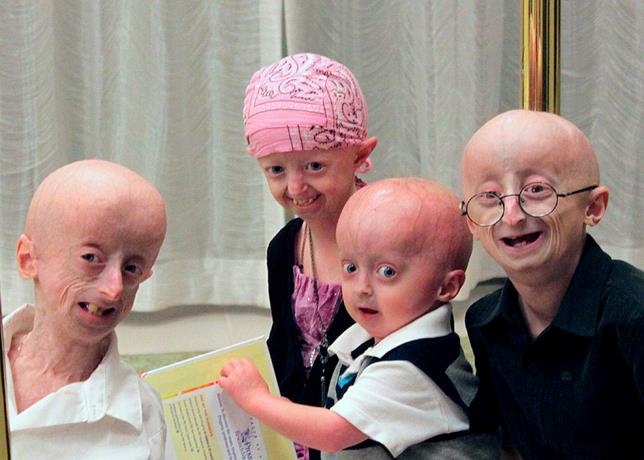 progeria.jpeg