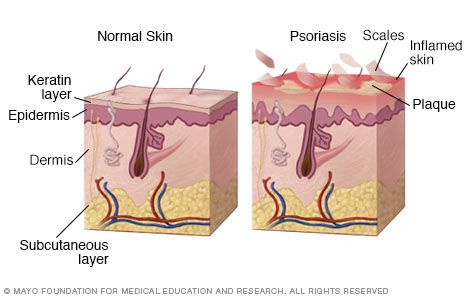 Un estudio de Novartis muestra que los pacientes con psoriasis desean efectos terapéuticos más allá del aclaramiento de la piel