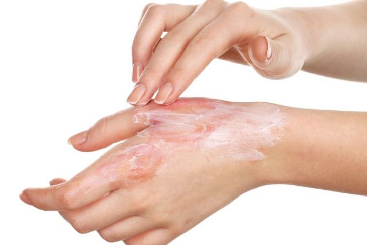 Uso de roflumilast tópico para la dermatitis seborreica