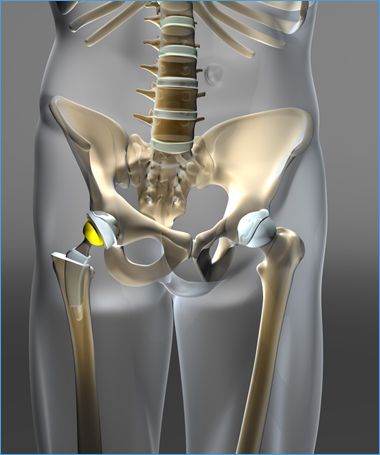 Artroplastia total de cadera primaria con vástagos cortos en pacientes menores de 20 años 