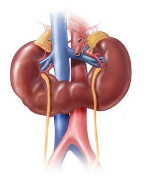 Nefrectomia parcial robótica en paciente con riñón en herradura