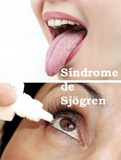 Síndrome de Sjögren primario: autoanticuerpos y su relación con las manifestaciones clínicas y la histología de las glándulas salivales menores