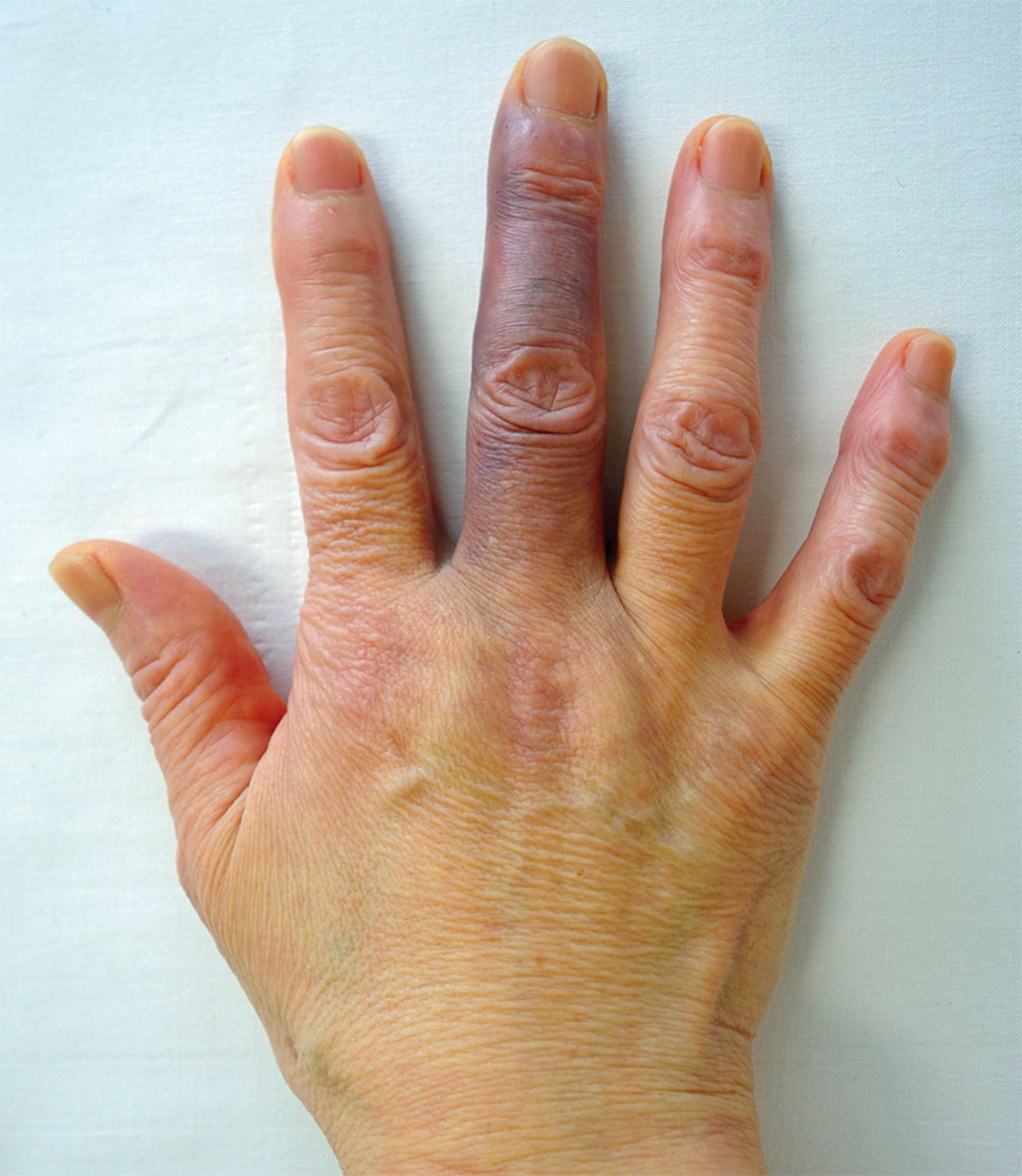 Reporte de casos de síndrome de dedo azul