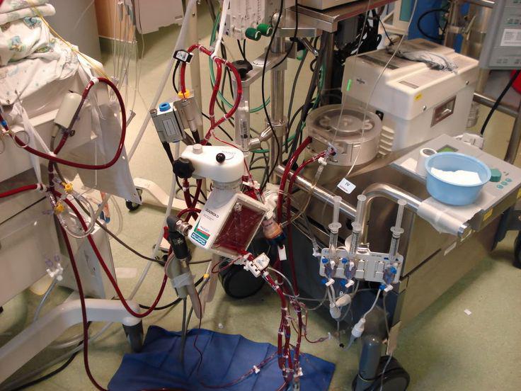 Oxigenación por Membrana Extracorpórea Venoarterial en Pacientes Infarto Complicado con Shock Cardiogénico